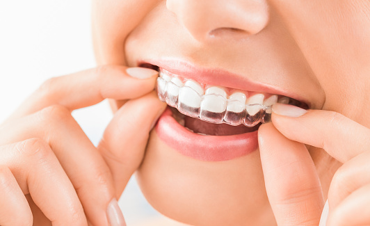 Close up of woman placing guard into mouth at Hometown Dental in McMinnville, OR Close up of woman placing guard into mouth at Hometown Dental in McMinnville, OR